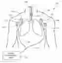 Fig. 01 - System for positioning an intubation tube