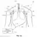 Fig. 02 - System for positioning an intubation tube