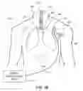Fig. 03 - System for positioning an intubation tube