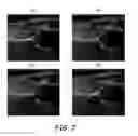Fig. 06 - Surface modeling of a segmented echogenic structure for detection and measurement of anatomical anomalies