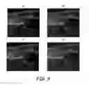 Fig. 08 - Surface modeling of a segmented echogenic structure for detection and measurement of anatomical anomalies