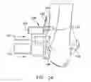 Fig. 23 - Patient specific surgical guide locator and mount