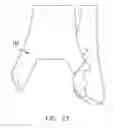 Fig. 24 - Patient specific surgical guide locator and mount