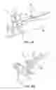 Fig. 07 - Ankle replacement system and method