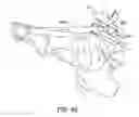 Fig. 37 - Ankle replacement system and method