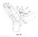 Fig. 45 - Ankle replacement system and method