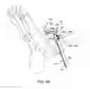 Fig. 46 - Ankle replacement system and method