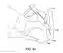 Fig. 61 - Ankle replacement system and method