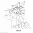 Fig. 65 - Ankle replacement system and method