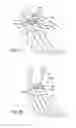 Fig. 70 - Ankle replacement system and method