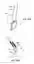 Fig. 78 - Ankle replacement system and method