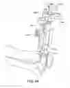 Fig. 79 - Ankle replacement system and method