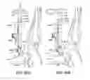 Fig. 80 - Ankle replacement system and method