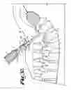 Fig. 14 - SPINAL FIXATION TOOL ATTACHMENT STRUCTURE