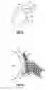 Fig. 02 - Instrumentation and technique for sizing a bone reconstruction graft