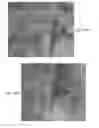 Fig. 74 - Catheter apparatuses, systems, and methods for renal neuromodulation