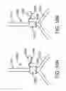 Fig. 08 - Devices and methods for assisting valve function, replacing venous valves, and predicting valve treatment success
