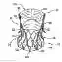 Fig. 01 - Sinus-engaging valve fixation member