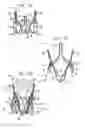 Fig. 05 - Sinus-engaging valve fixation member
