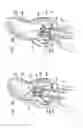 Fig. 09 - Sinus-engaging valve fixation member