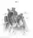 Fig. 04 - SYSTEM AND METHOD FOR REPLACING AN INFLAMED OR INFECTED HEART VALVE