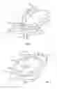 Fig. 02 - Transforaminal prosthetic spinal disc apparatus