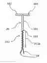 Fig. 01 - Intrauterine device with a restricted upward movement of a string