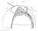 Fig. 01 - Intraocular shunt placement