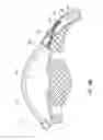Fig. 13 - Intraocular shunt placement