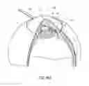 Fig. 14 - Intraocular shunt placement