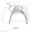 Fig. 15 - Intraocular shunt placement