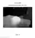 Fig. 11 - Foamable formulation