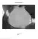 Fig. 78 - Foamable formulation