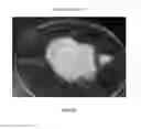 Fig. 82 - Foamable formulation