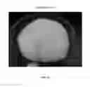 Fig. 87 - Foamable formulation