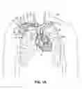 Fig. 02 - Devices, methods and systems for establishing supplemental blood flow in the circulatory system