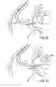 Fig. 05 - Devices, methods and systems for establishing supplemental blood flow in the circulatory system