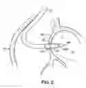 Fig. 11 - Devices, methods and systems for establishing supplemental blood flow in the circulatory system
