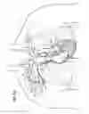 Fig. 12 - Devices, methods and systems for establishing supplemental blood flow in the circulatory system