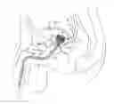 Fig. 01 - Catheter device and method for inducing negative pressure in a patient's bladder