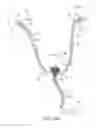 Fig. 10 - Catheter device and method for inducing negative pressure in a patient's bladder