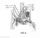 Fig. 03 - Methods and systems for treating acute heart failure by neuromodulation