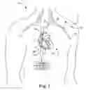 Fig. 02 - Methods and devices for producing trabecular fibers