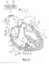 Fig. 06 - Methods and devices for producing trabecular fibers