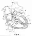 Fig. 07 - Methods and devices for producing trabecular fibers