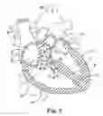 Fig. 09 - Methods and devices for producing trabecular fibers