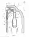 Fig. 04 - Torque converter with a finger-tabbed brazed inertia ring