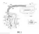 Fig. 02 - Phenotyping sensor patterns to identify and treat heart failure