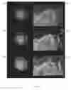 Fig. 07 - Waveform enhanced reflection and margin boundary characterization for ultrasound tomography
