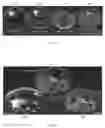 Fig. 08 - Waveform enhanced reflection and margin boundary characterization for ultrasound tomography
